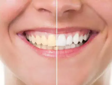 Clareamento Dental: 17 dúvidas mais frequentes respondidas nesse guia completo!