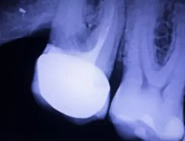 Radiografia do dente: o que é, tipos e quanto custa?