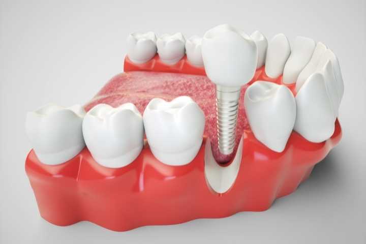 Implante dentário dói