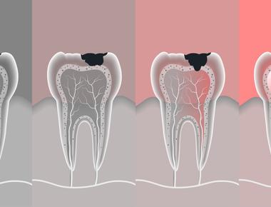 5 cuidados após fazer canal no dente que podem acelerar sua recuperação