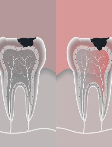 5 cuidados após fazer canal no dente que podem acelerar sua recuperação
