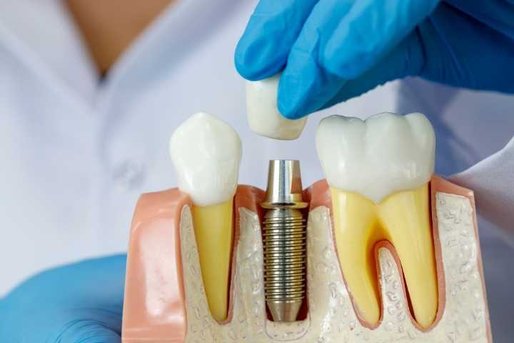 Cirurgia de implante dentário