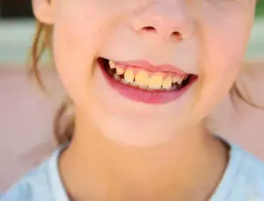 Dentes amarelados: como clarear e conquistar o sorriso perfeito?