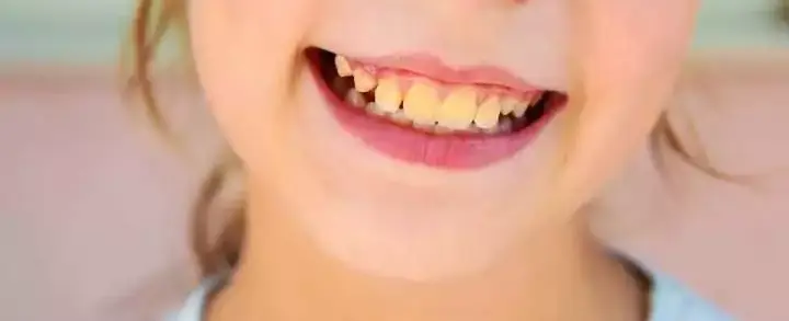 Dentes amarelados: como clarear e conquistar o sorriso perfeito?
