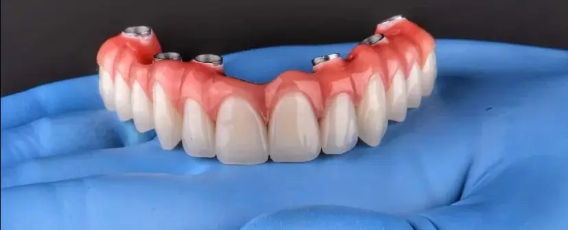 Conheça os tipos de implantes dentários e volte a sorrir!
