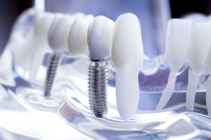 Implante Dentário de um ou vários dentes