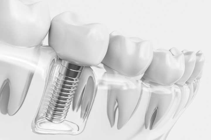 Como é o processo de Implante Dentário
