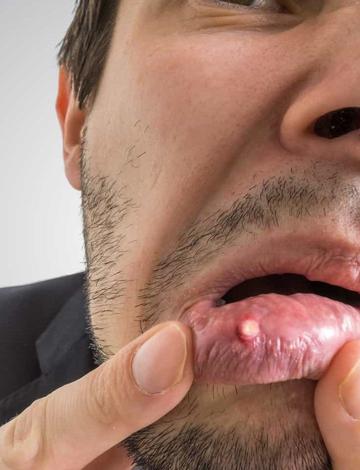 O que é bom para afta na boca? 5 dicas seguras e aprovadas por dentistas