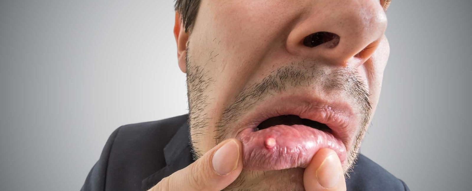 O que é bom para afta na boca? 5 dicas seguras e aprovadas por dentistas