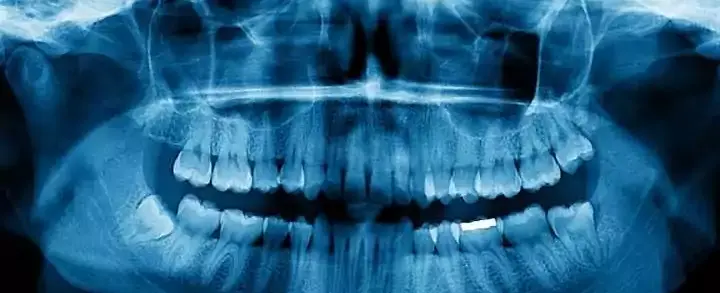 Panorâmica dos dentes: conheça o exame e sua importância