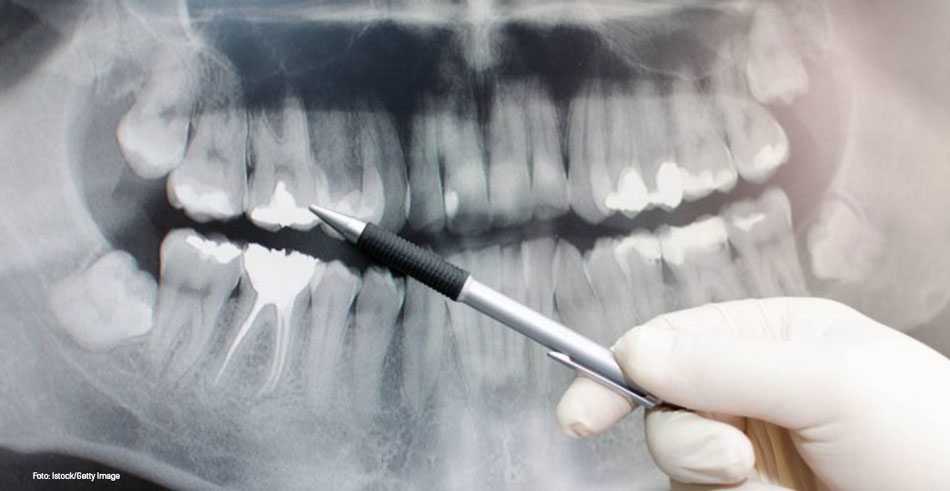 raio-x arcada dentária
